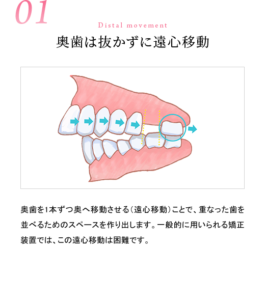 01奥歯は抜かずに遠心移動／奥歯を１本ずつ奥へ移動させる（遠心移動）ことで、重なった歯を並べるためのスペースを作り出します。一般的に用いられる矯正装置では、この遠心移動は困難です。