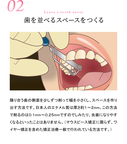 02歯を並べるスペースをつくる／隣り合う歯の側面を少しずつ削って幅を小さくし、スペースを作り出す方法です。日本人のエナメル質は厚さ１〜２mm。この方法で削るのは0.1mm〜0.25mmですのでしみたり、虫歯になりやすくなるといったことはありません。（マウスピース矯正に限らず、ワイヤー矯正を含めた矯正治療一般で行われている方法です。）